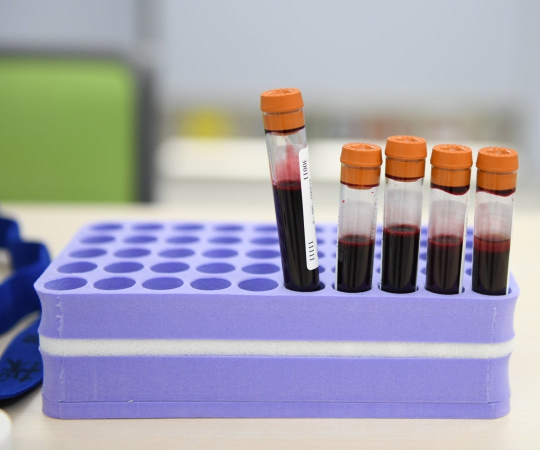 Nuevos análisis de sangre para Alzheimer pueden cambiar las reglas del juego tratarla