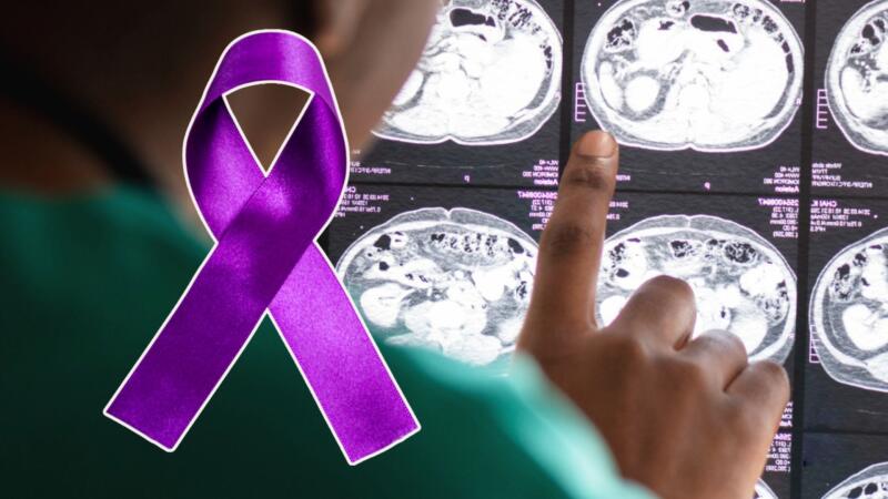 Día mundial de la epilepsia: ¿qué tan común es esta condición? Día mundial de la epilepsia: ¿qué tan común es esta condición?